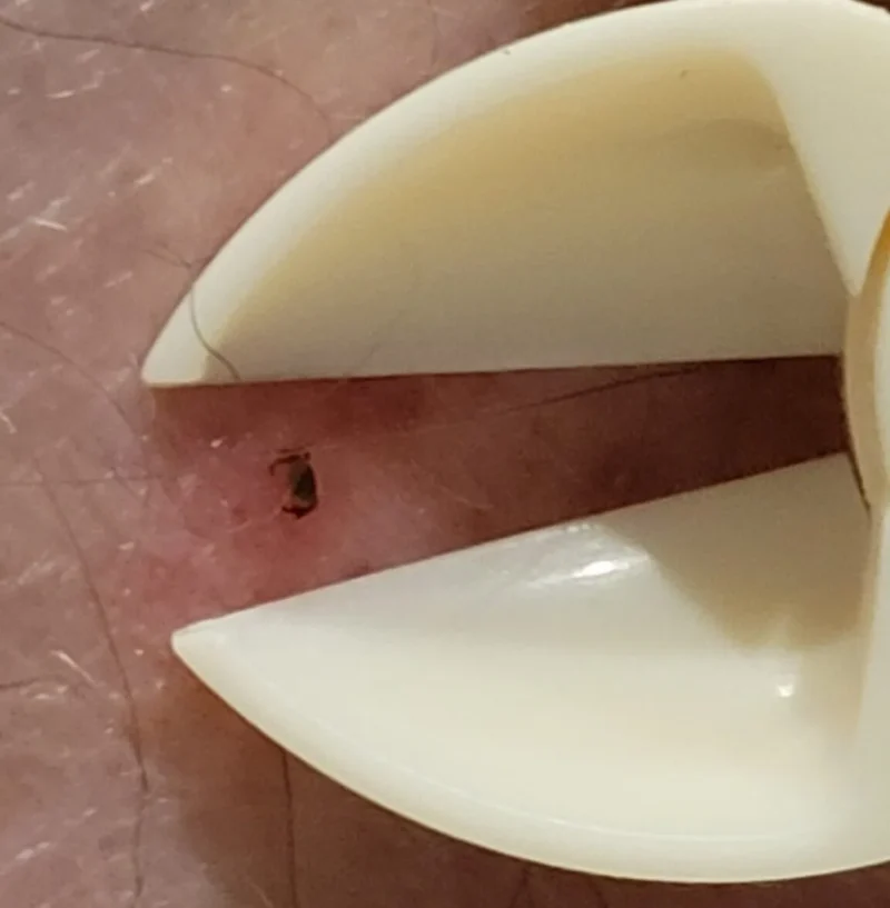 Tick Nipper2 Tick Nipper